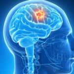 La terapia con protones para niños con tumor cerebral aporta mejores resultados neurocognitivos que los rayos X