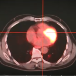 Radiaciones ionizantes para el tratamiento contra el cáncer